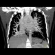 Scimitar syndrome, scimitar sign, anomalous return of pulmonary vein, dextroposition of heart: CT - Computed tomography
